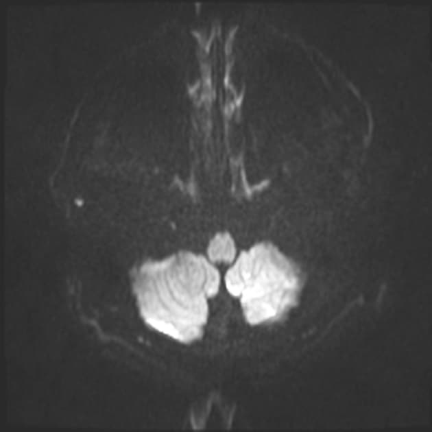 Cerebral Abscess (Áp xe não)