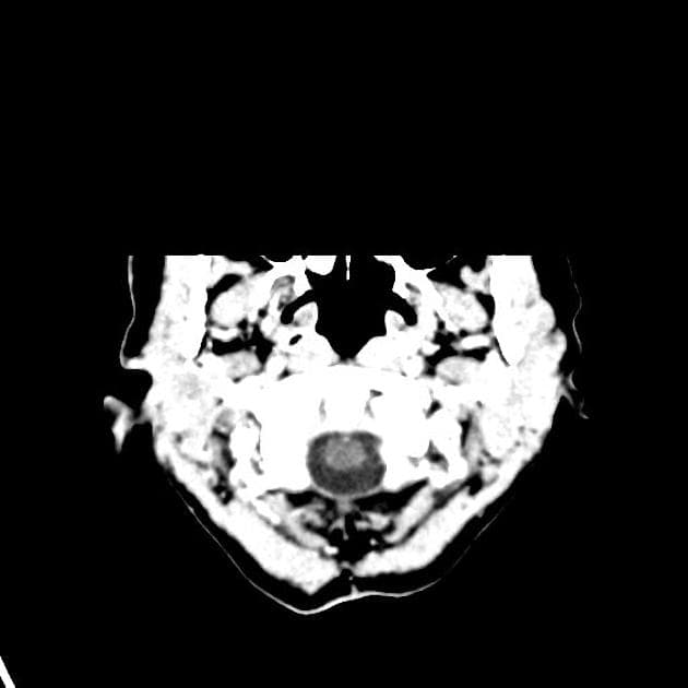 Glioblastoma IDH wild-type (haemorrhagic)