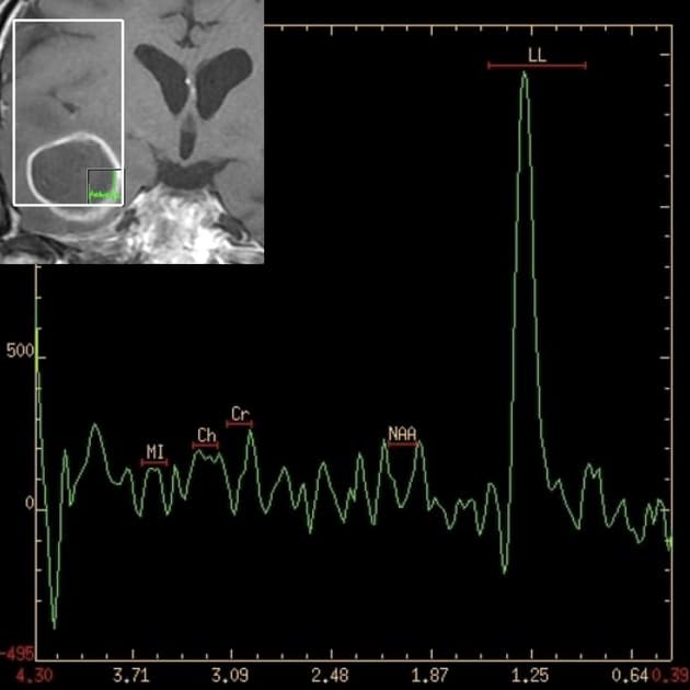 Skull Base Osteomyelitis and Temporal Lobe Abscess (Viêm xương sọ đáy và áp xe thùy thái dương)