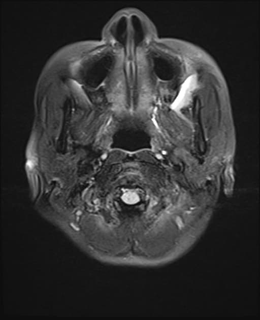 Intracranial metastases
