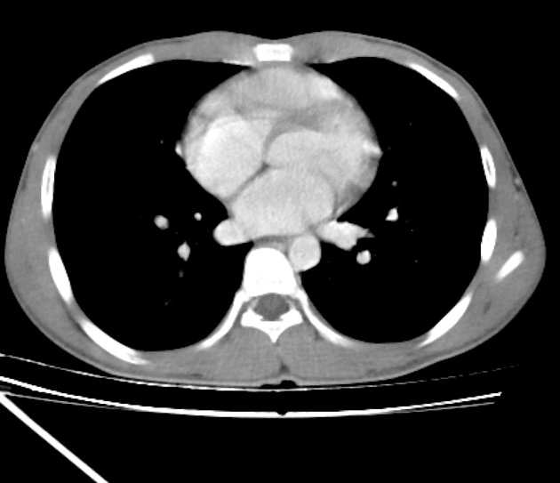 Liver Trauma - AAST Grade IV (Chấn thương gan - độ IV theo phân loại AAST)