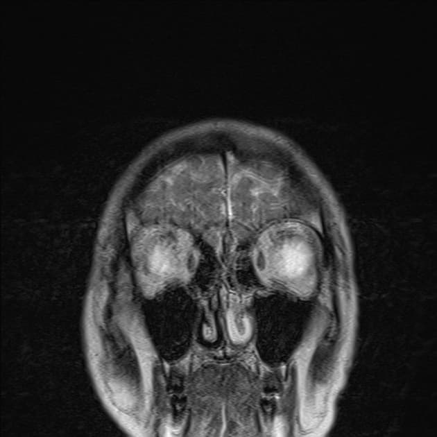 High grade glioma with haemorrhage