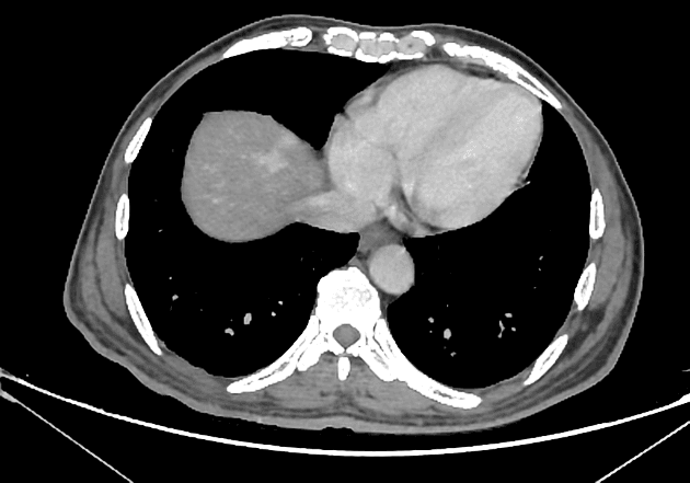 Liver abscess with hepatic perfusion disorders
