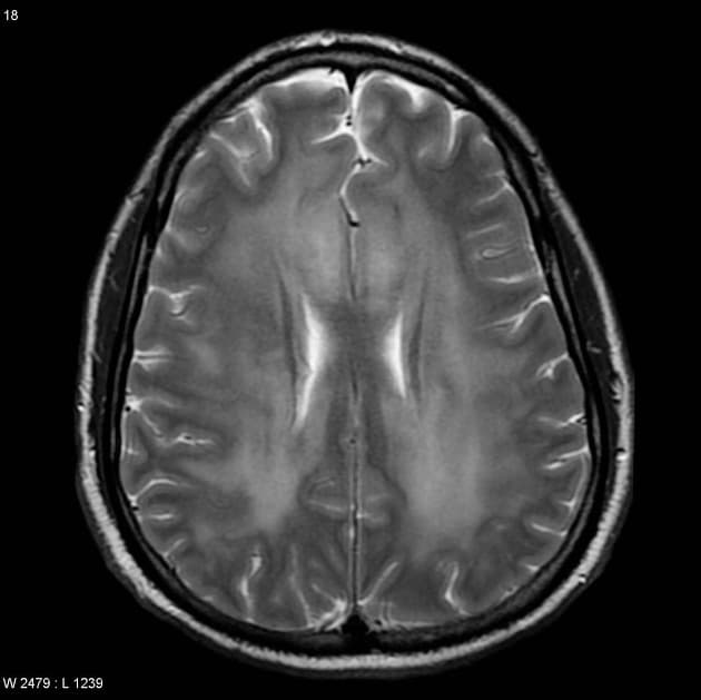 Toxic Leukoencephalopathy due to Methotrexate (Bệnh lý chất trắng do độc chất – methotrexate)