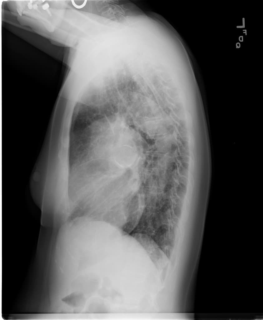 Patent ductus arteriosus