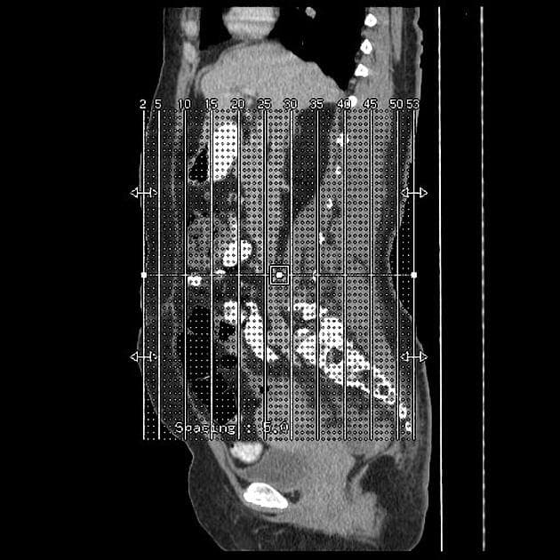 Deep pelvic endometriosis (MRI)