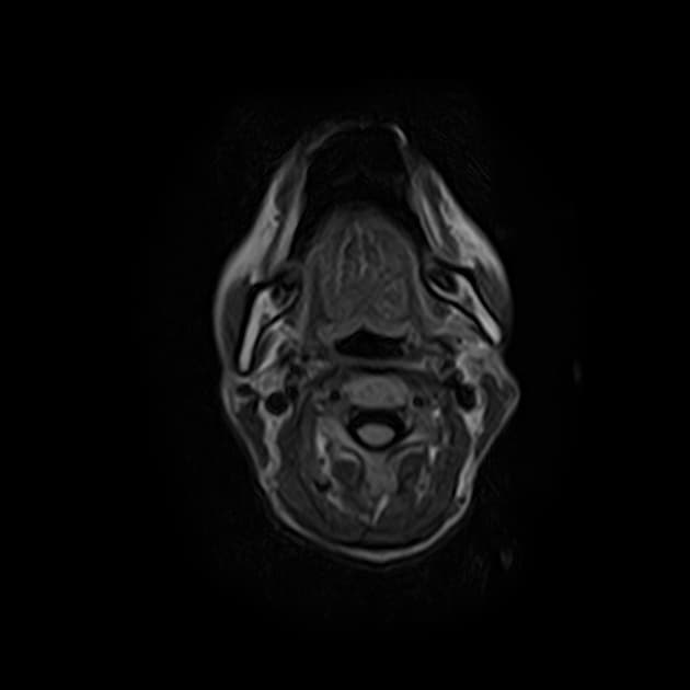 Toxic Leukoencephalopathy Due to Chemotherapy (Bệnh lý chất trắng do độc chất)