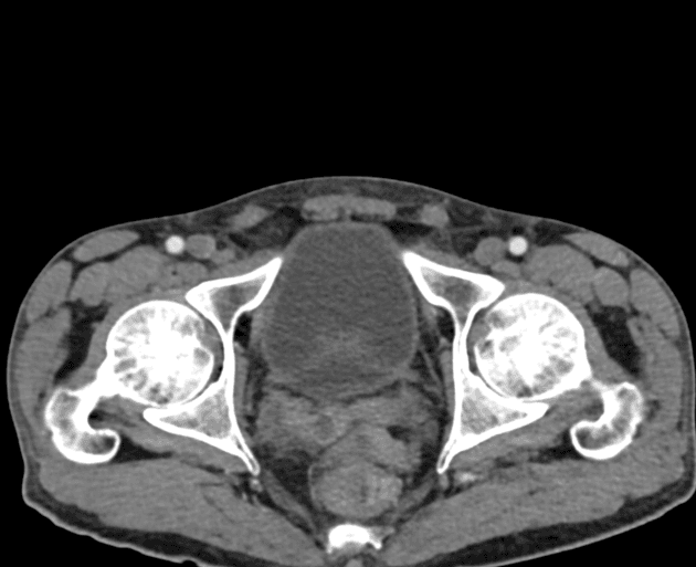 Ileocecal tuberculosis