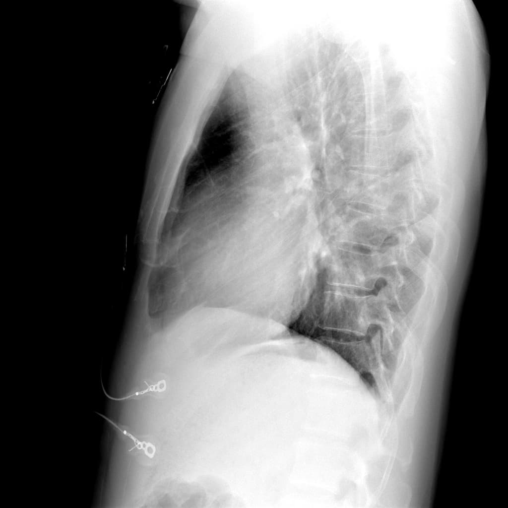 Right Atrial Angiosarcoma (U ác tính mạch máu tâm nhĩ phải (angiosarcoma))