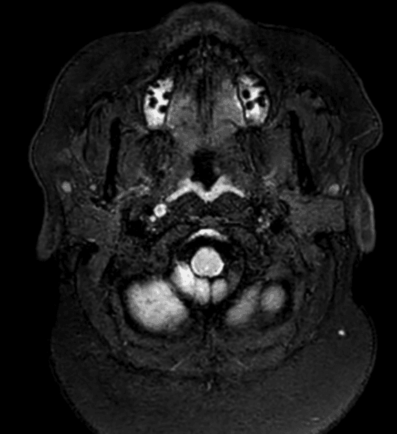 Multiple Sclerosis (Xơ cứng rải rác)
