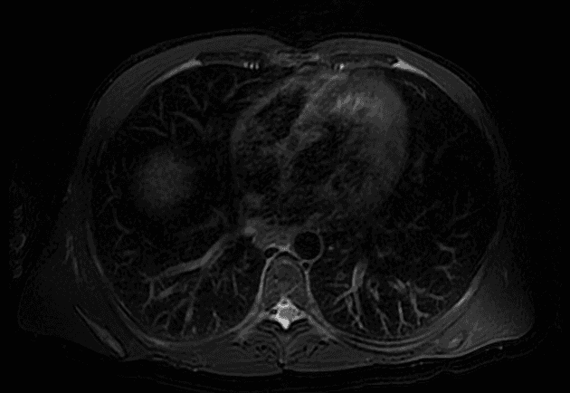 Pancreatic edema due to cirrhosis