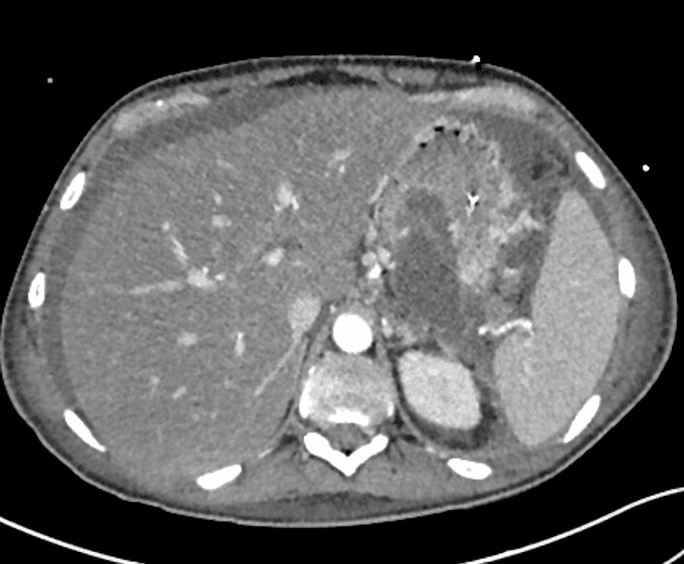 Acute pancreatitis