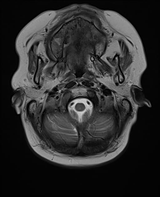Haemorrhagic brain metastases