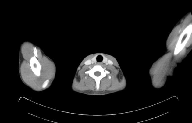 Gunshot Injury with Hepatic Laceration, Perinephric Hematoma, and Urinoma (Chấn thương do đạn súng)
