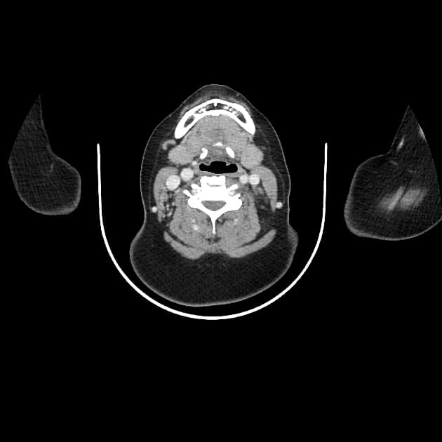 Multiple congenital mediastinal vascular anomalies