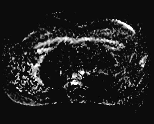 Hepatic hemangioma