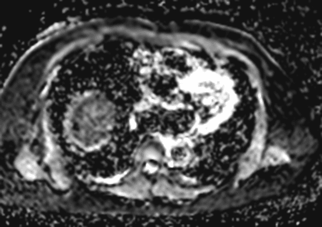 Hepatic haemangiomatosis