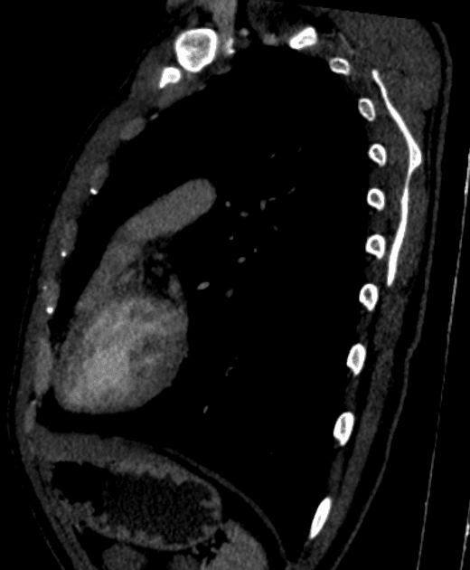 Patent ductus arteriosus with ascending aortic aneurysm
