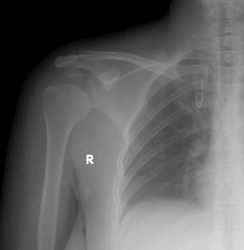 Supraspinatus calcific tendinitis with intramascular migration