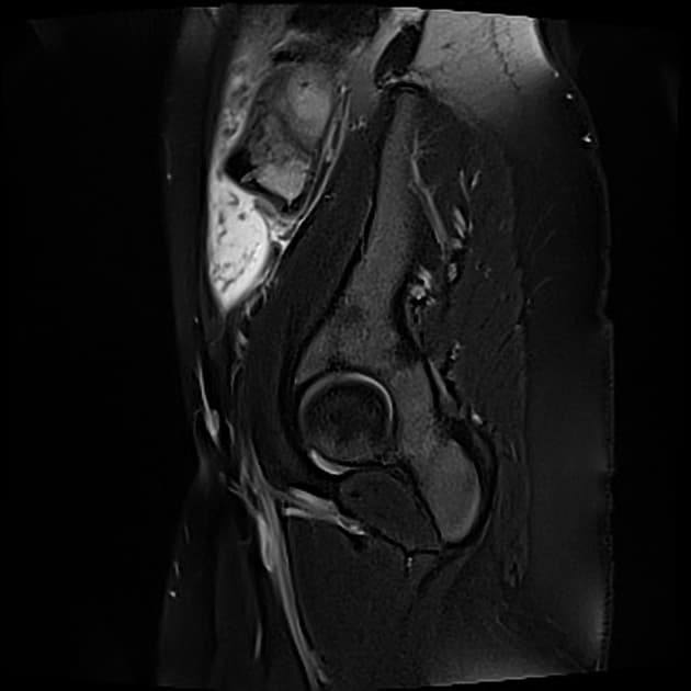 Pelvic-peritoneal tuberculosis