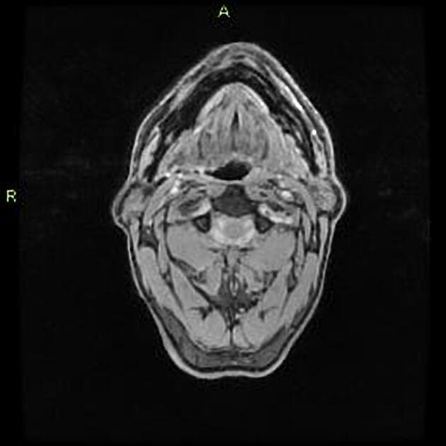 Glioblastoma, IDH-wildtype (ASL perfusion)