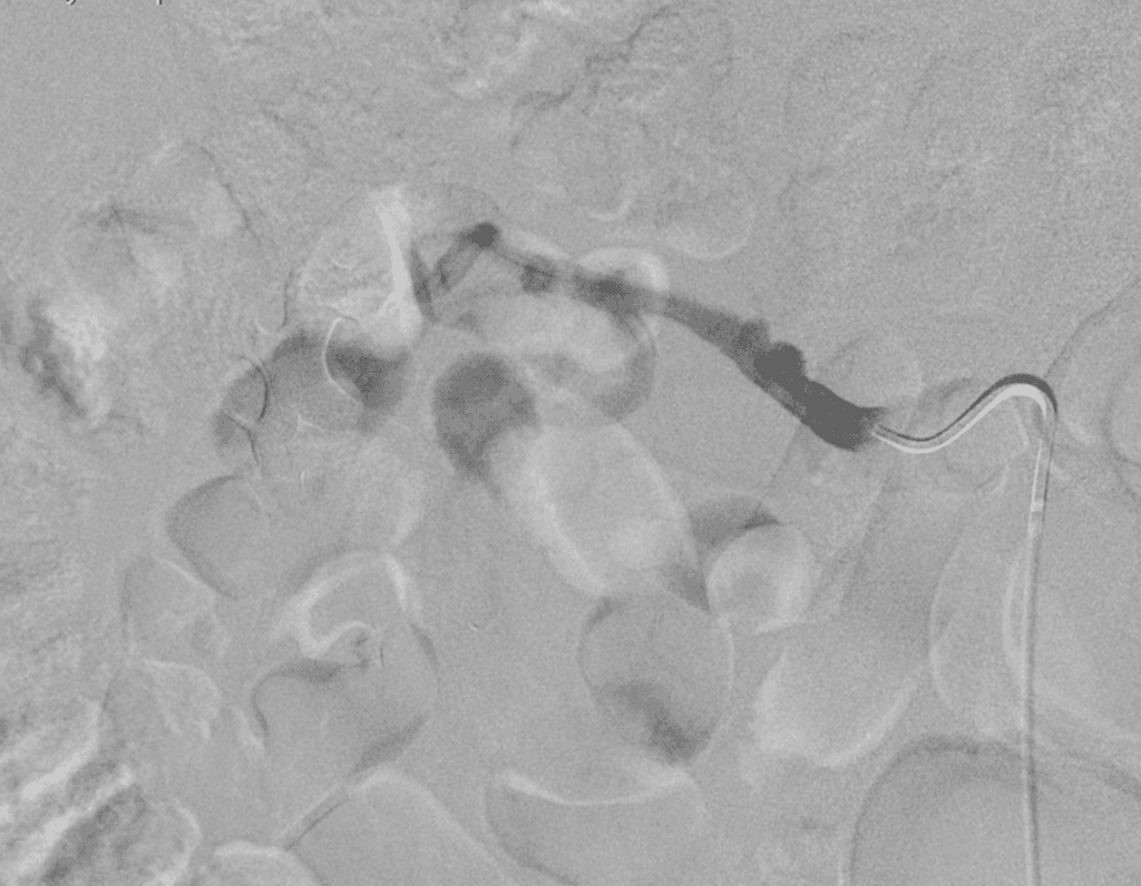 Fibromuscular dysplasia right renal artery