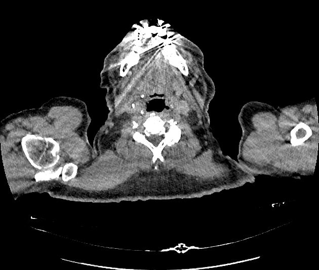 Oncocytoma in Horseshoe Kidney (U oncocytoma trên thận móng ngựa)