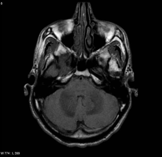 Leukoencephalopathy due to Heroin Inhalation (Chasing the dragon)
