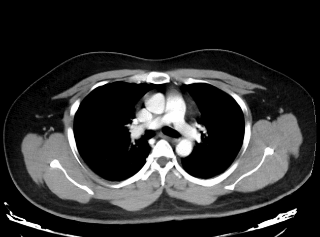 Porto-mesenteric venous thrombosis