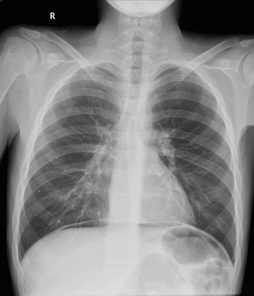 Colonic perforation in Crohn disease