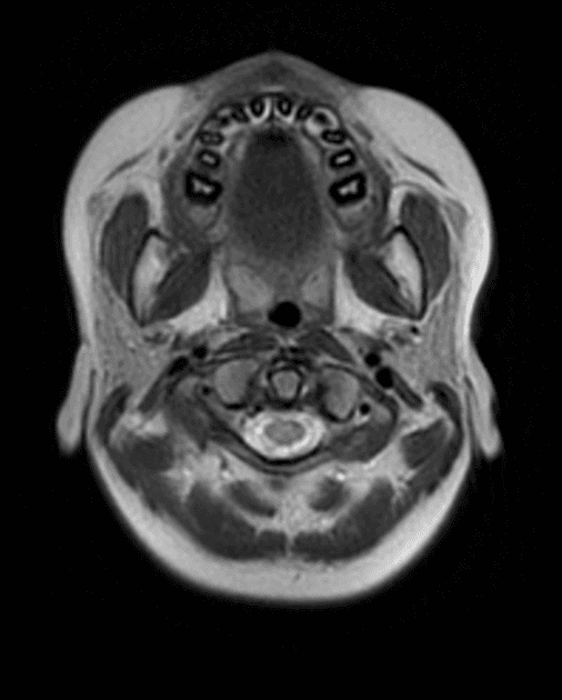 Pediatric-Onset Multiple Sclerosis (Đa xơ cứng khởi phát ở nhi khoa)