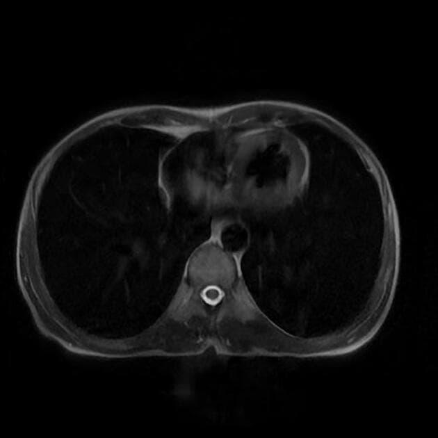 Cervical carcinoma - stage IIIC1