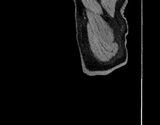 Left Atrial Posterior Wall Intramural Hematoma (Khối máu tụ thành trong thành sau tâm nhĩ trái)