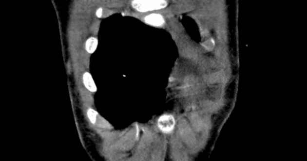 Coronary cameral fistula with double chamber right ventricle