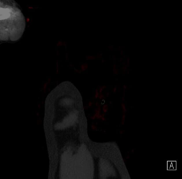 Pulmonary lobar torsion