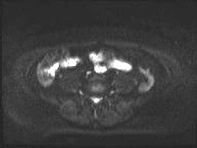 Cervical carcinoma - stage IIIC1