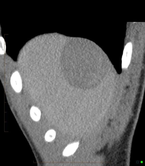 Chronic Subcapsular Hepatic Hematoma (Khối máu tụ dưới vỏ gan mạn tính)