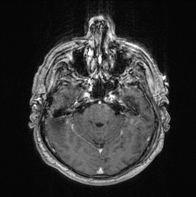 Glioblastoma NOS (large cystic component)