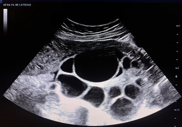 Twin Pregnancy with Ovarian Hyperstimulation Syndrome (Song thai kèm hội chứng quá kích buồng trứng)