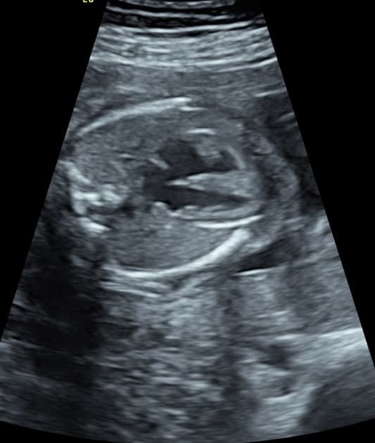 D-loop transposition of the great arteries - fetal echocardiogram
