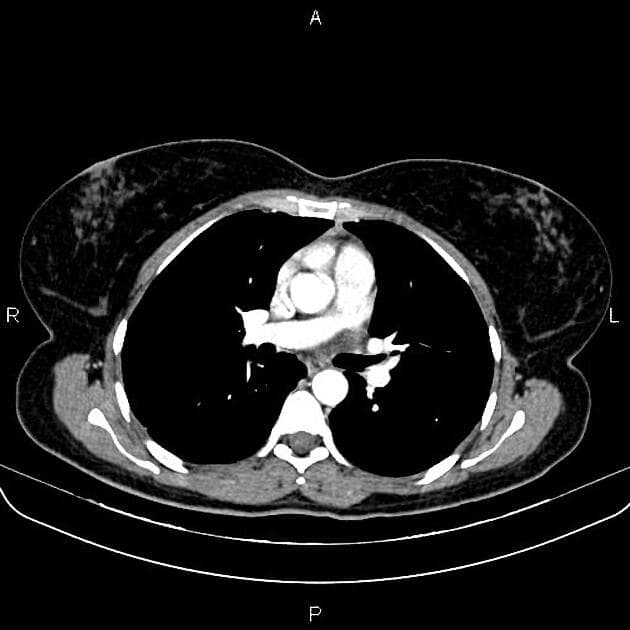Hepatic Epithelioid Hemangioendothelioma (Ung thư biểu mô mạch máu dạng biểu mô gan)