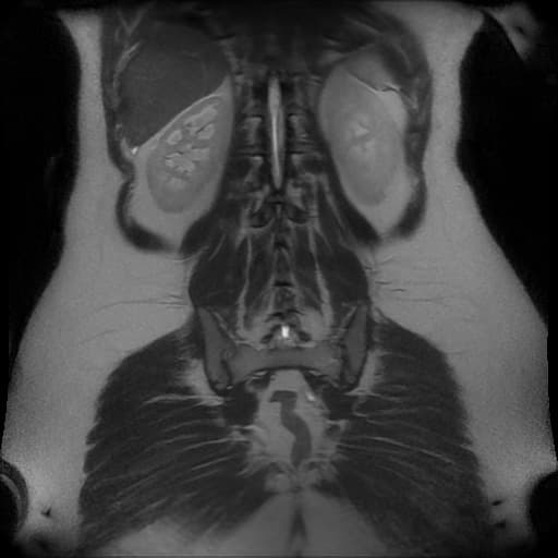 Acute appendicitis in pregnancy (MRI)