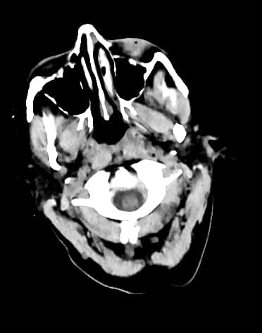 Middle cerebral artery infarct