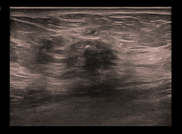 Invasive ductal carcinoma