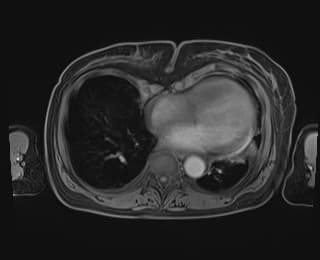 Gallbladder volvulus