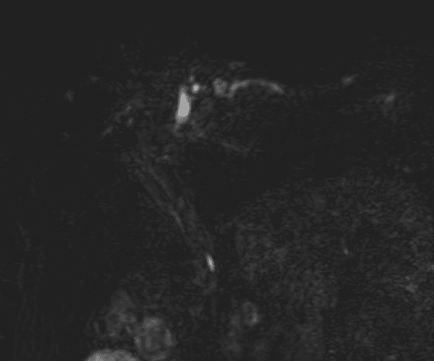 Long cystic duct remnant with choledocholithiasis after cholecystectomy