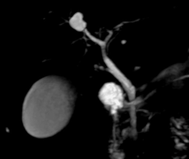 Diverticular Choledochal Cyst (Todani Type II) at the Distal Common Bile Duct (U nang ống mật chủ dạng túi thừa (Todani type II) tại đoạn xa ống mật chủ)