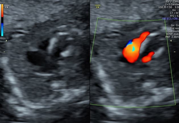 Endocardial Fibroelastosis Detected on Fetal Echocardiography (Xơ đàn hồi nội tâm mạc (siêu âm tim thai))