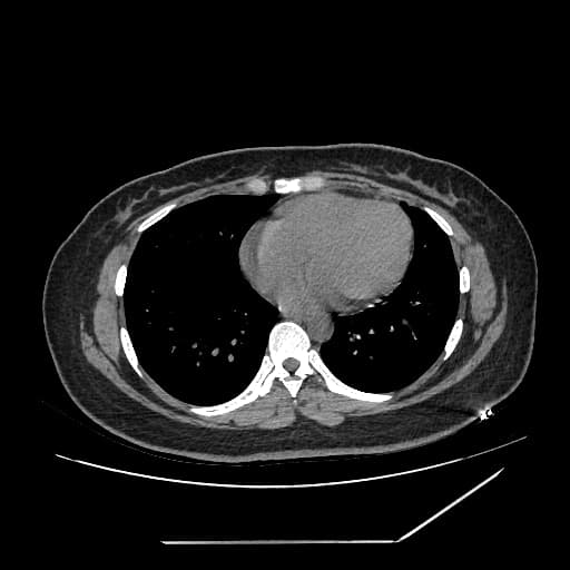 Meckel's diverticulum perforated by fishbone