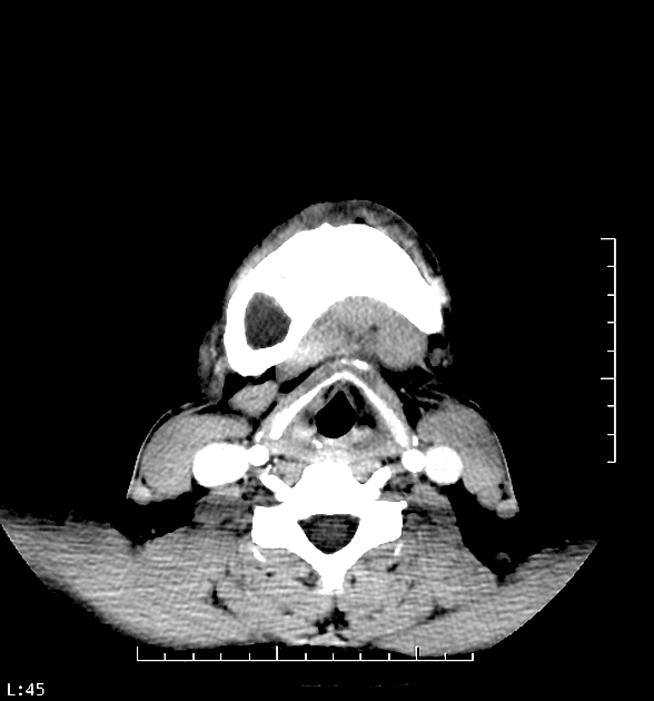 Craniofacial fibrous dysplasia